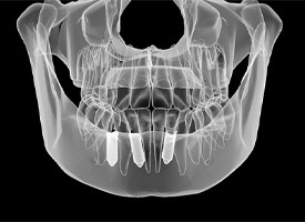 digital image of implant posts