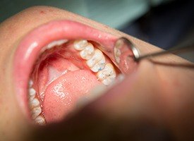 Closeup of patient receiving dental treatment