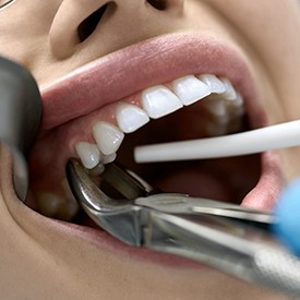 Closeup of forceps grasping a patient’s tooth for extraction