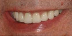 Closeup of man's smile after tooth repair and teeth whitening