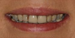 Closeup of woman's discolored and damged teeth