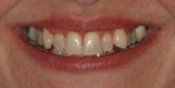 Closeup of woman's yellowed and uneven teeth