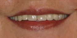 Closeup of older woman's discolored teeth