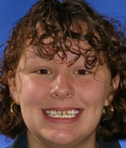 Young woman with decayed and discolored front teeth