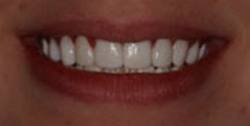 Closeup of young woman's flawless smile after repair