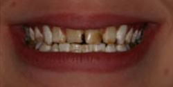 Closeup of young woman's decayed and dicolored front teeth