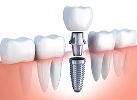 diagram of dental implant, abutment, and crown 