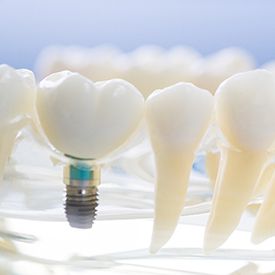 Plastic model of a dental implant. 
