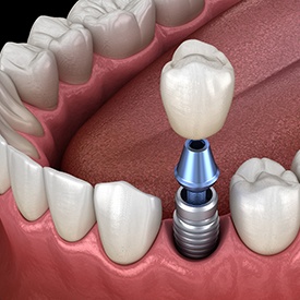 Image showing each part of a dental implant. 