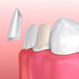 model of veneers