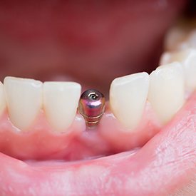 A closeup of a dental implant inside a mouth.