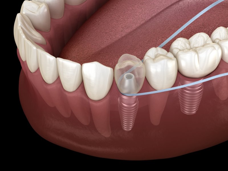 Flossing dental implants