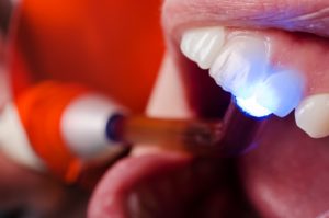 Dental bonding procedure on front tooth