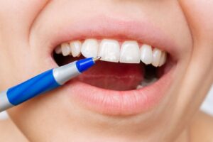 Closeup of someone pointing to white spots on their teeth with a pen